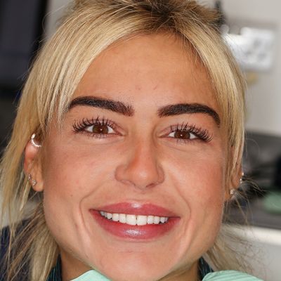 Composite Bonding - Smile 24 before